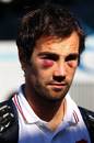 France's Morgan Parra sports two black eyes in the aftermath of the World Cup final