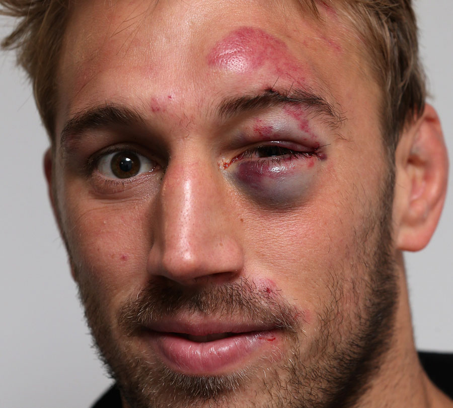 Quins flanker Chris Robshaw shows off his eye injury