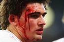 England's Toby Flood shows some battle scars